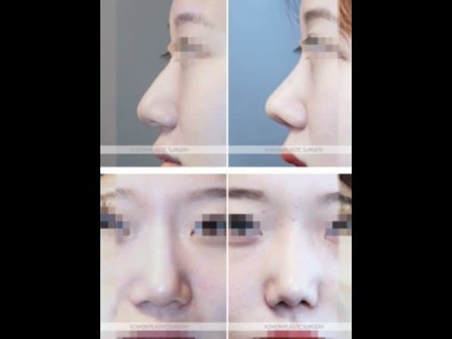 코원성형외과 코 성형 ★Before & After special ★