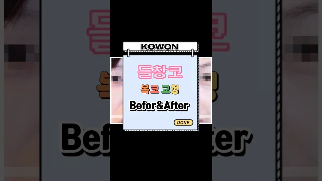 코원 코 수술증례 | 들창코 복코 교정 전 후