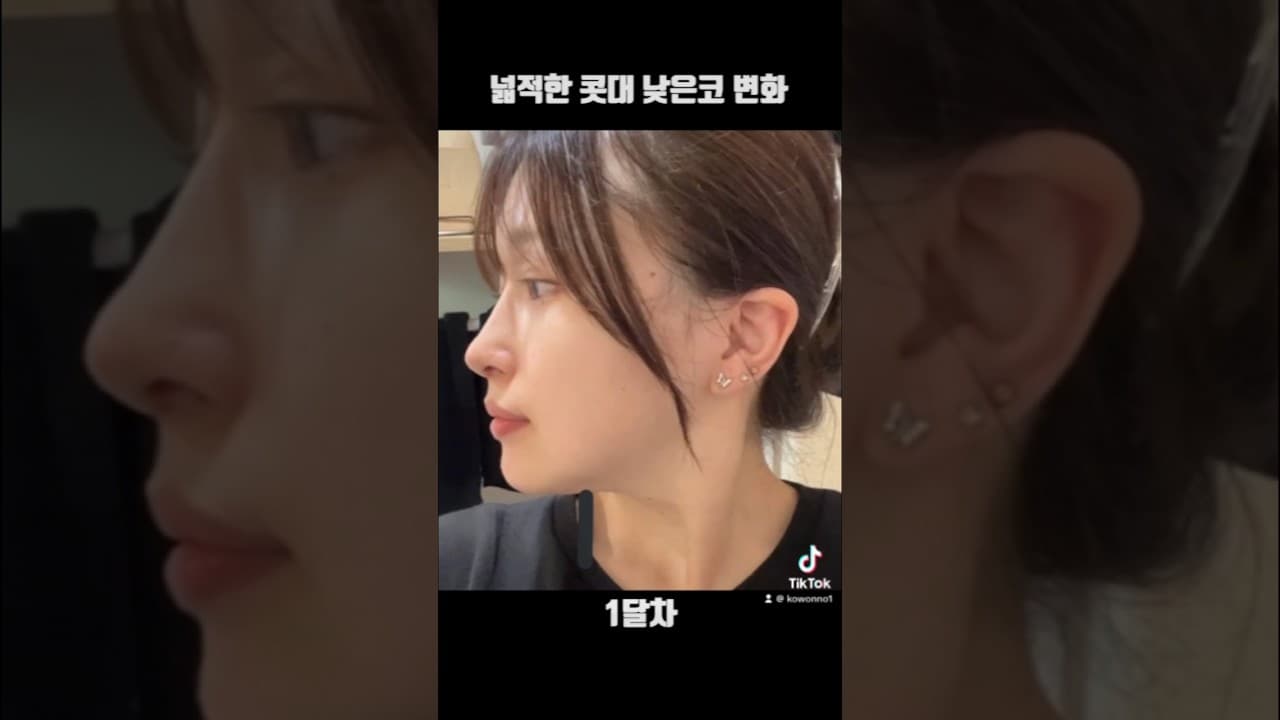 낮은코 넓은 콧대 코성형