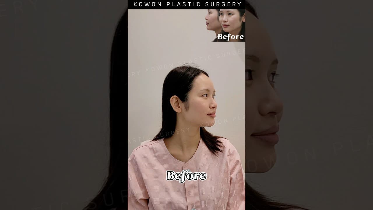 퍼진코 + 낮은코 수술했더니?