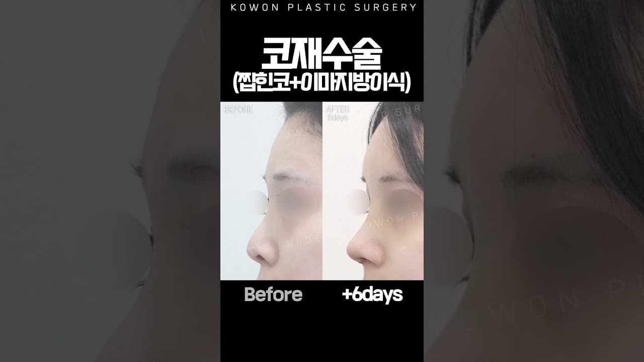 이마지방이식 + 코라인 교정, 동시에 하면? #코원성형외과 #kbeauty