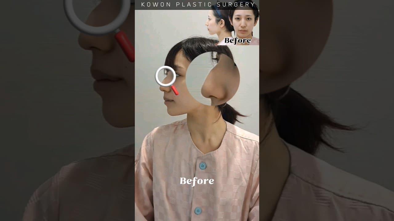 심한 매부리 교정 매끄러운 콧등(코원성형외과 매부리코 교정 3달차까지)