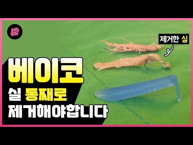 코성형 코시술 실 한꺼번에 제거하는 것이 좋은 이유? | 베이코, 하이코, 미스코