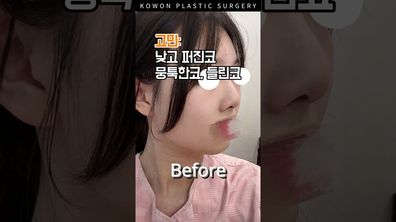 콧구멍보이던 낮고 퍼진코 한번에 개선가능?