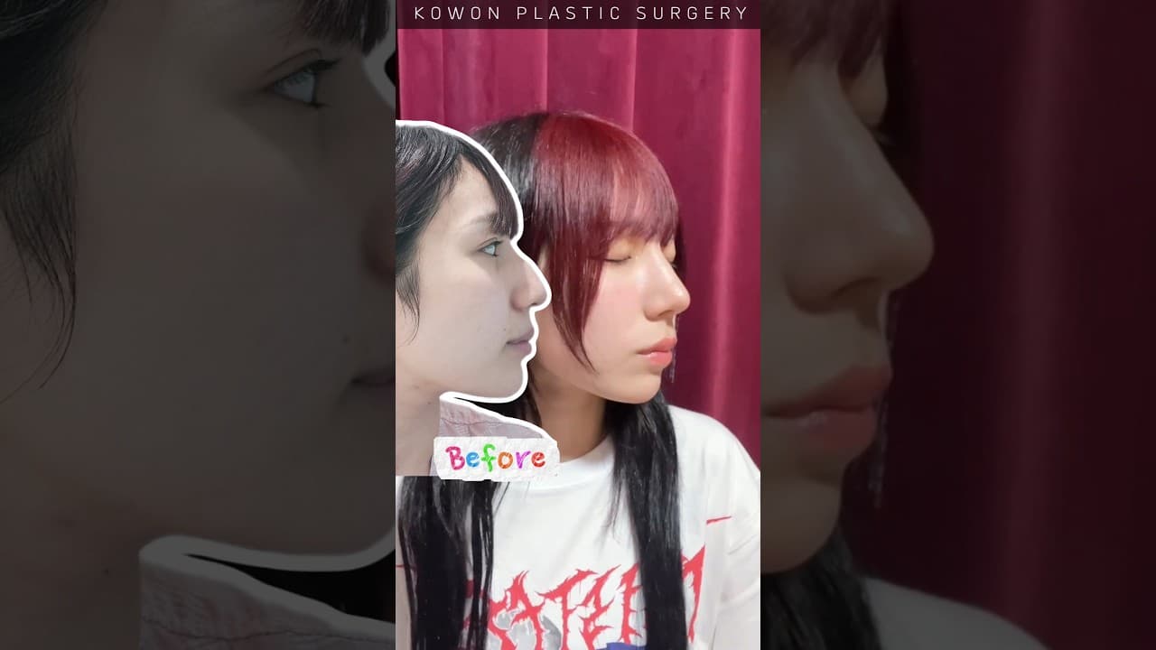 심한 매부리코 수술했더니?