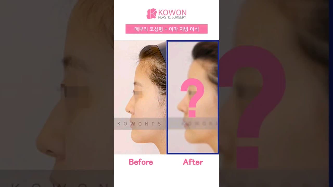 코원성형외과 | 매부리코교정+지방이식コウォン整形外科 | わし鼻矯正＋脂肪移植