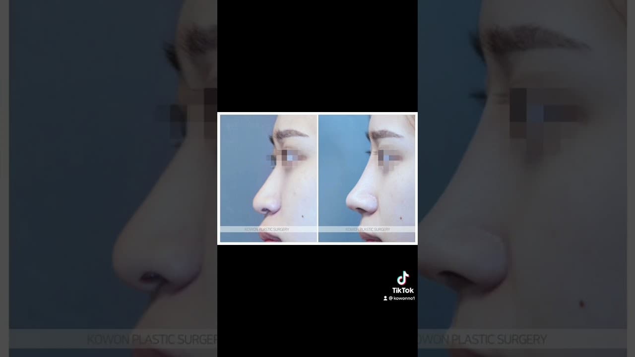 코원성형외과 코 성형 ★Before & After★_긴코
