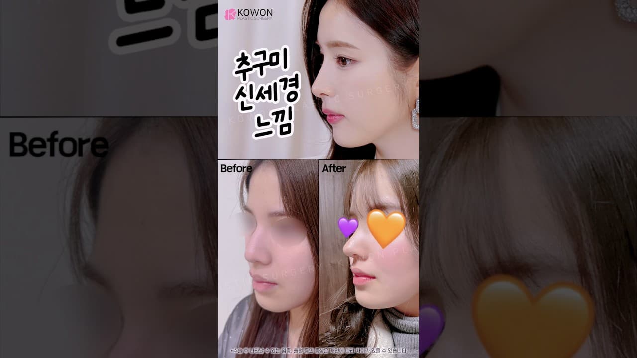 이 코 느낌 계속 찾음 (매부리코+미간꺼짐 교정)