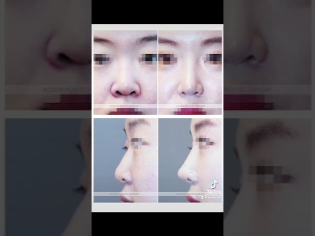 코원성형외과 코 성형 ★Before & After★_매부리코