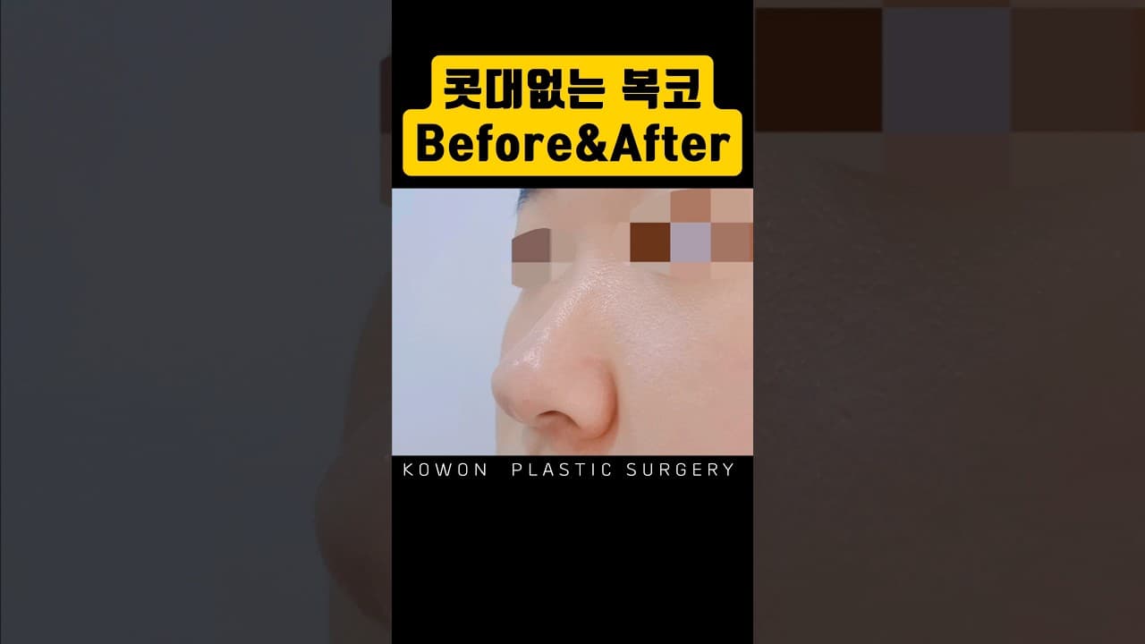 콧대 하나도 없는데 전형적인 복코라 교정했어요