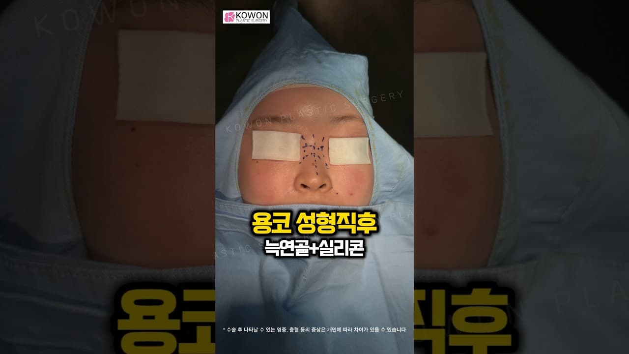 용코 성형직후 | 들린 콧구멍과 처진 비주 교정! 자가늑연골로 개선된 코성형 비포에프터 👃✨