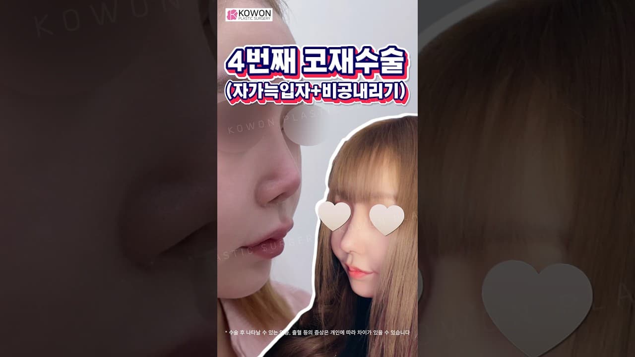 3번의 재수술 끝에 4번째 코수술… 드디어