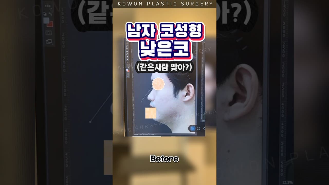 남자 코성형, 분위기 급변 레!전!드! #코원성형외과
