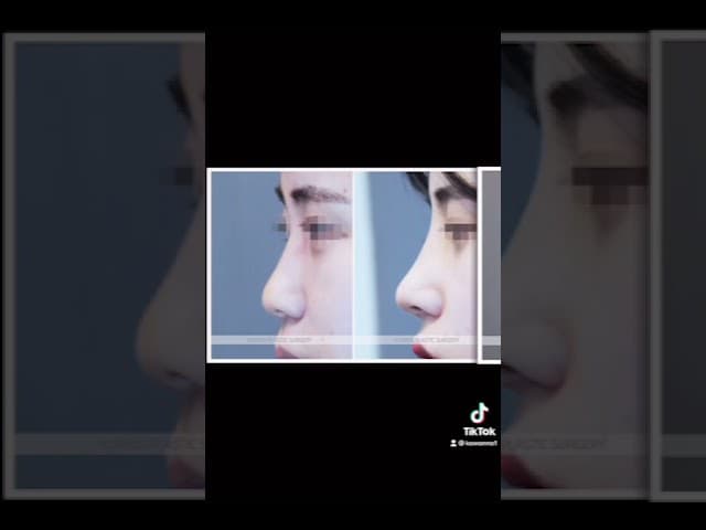 코원성형외과 코 성형 ★Before & After★_매부리코