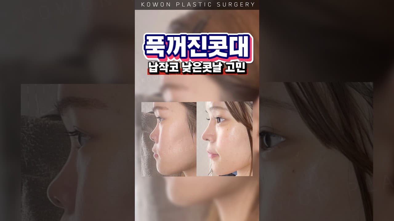 꺼진 콧대 얼굴 함몰감 고민 #코원성형외과