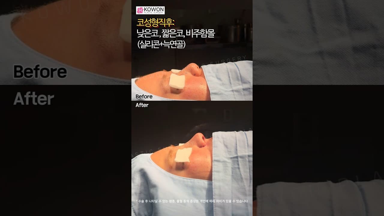 낮은코 짧은코 성형 직후 변화! 7일차 부기 확인 (코원성형외과)