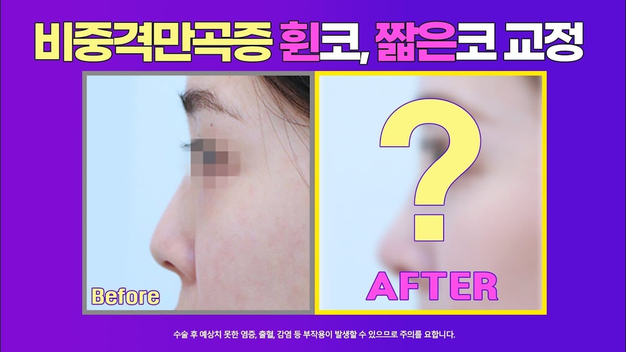 코원 짧은코수술 전후사진 : 비중격만곡증이 있고 코끝이 짧은 경우 여성스럽고 예쁜 코