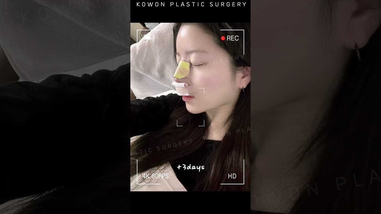 코수술 후 구축증상으로 코끝이 올라가 코원에서 코 재수술 #kbeauty #nosejob