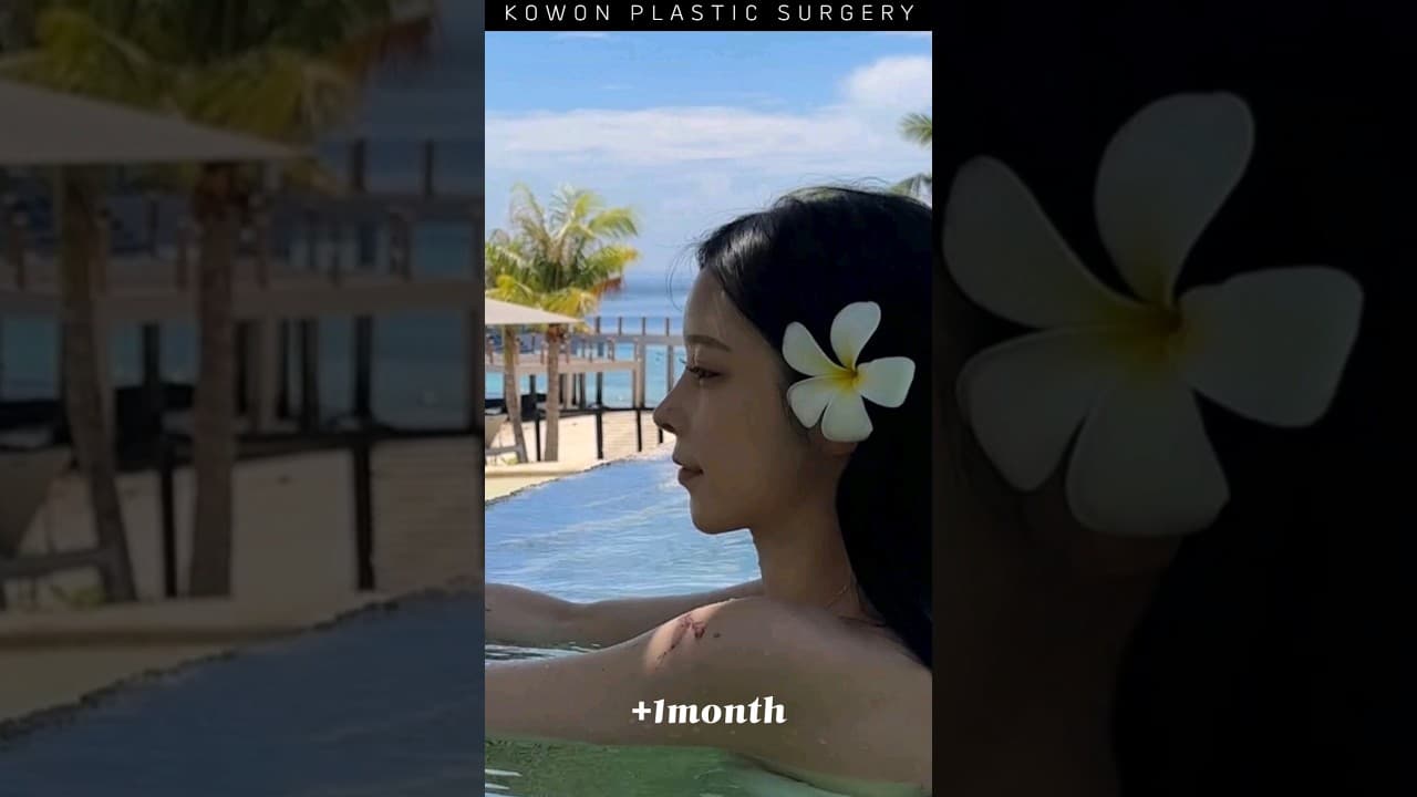 낮은코 최대한 화려하게 교정 원해요 😊(코원 낮은코교정+지방이식 전 후)