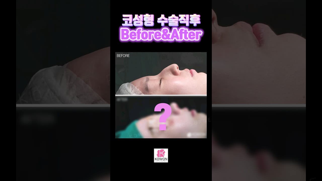 코원 코성형 수술직후 전 후 보기