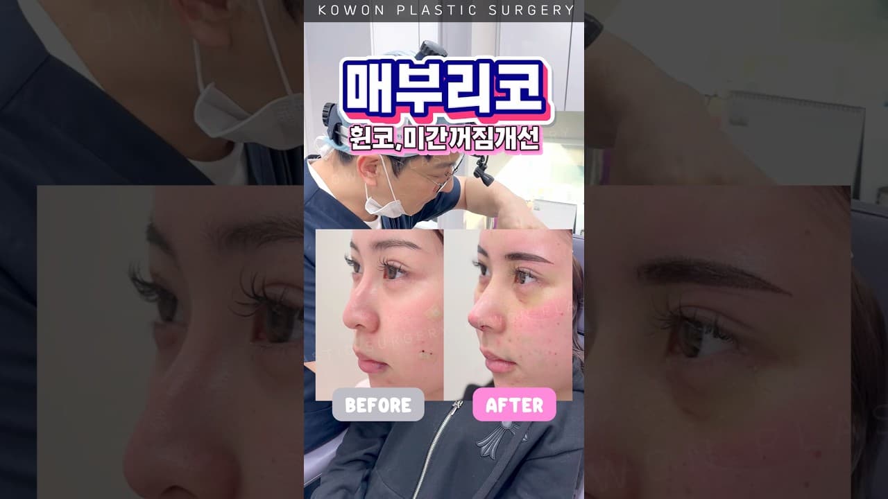 매부리코 휜코 같이 교정했더니?