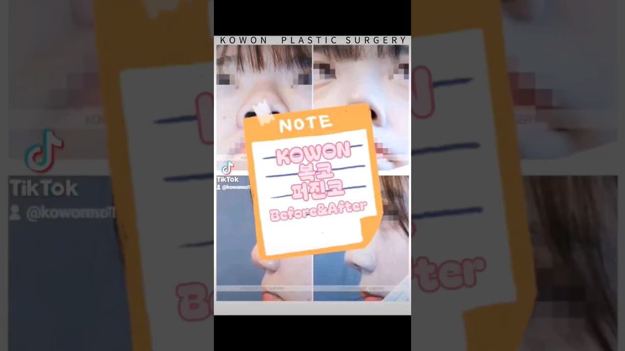 KOWON 복코, 퍼진코 Before&After