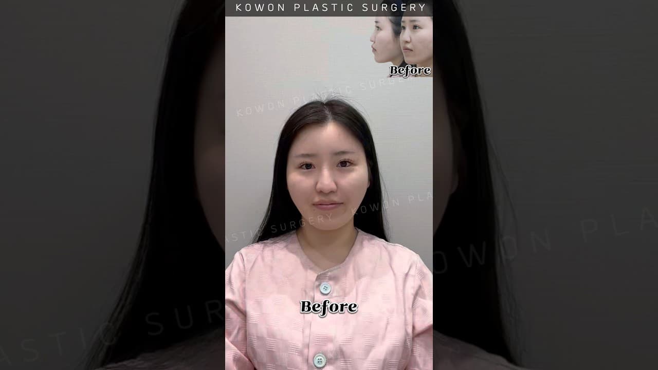 코끝처짐과 보형물 비침으로 코원에서 코재수술