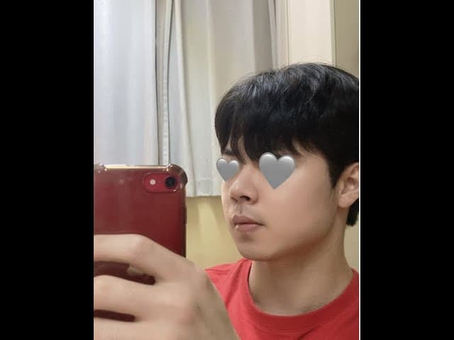 코원성형외과 코 성형 ★Before & After★