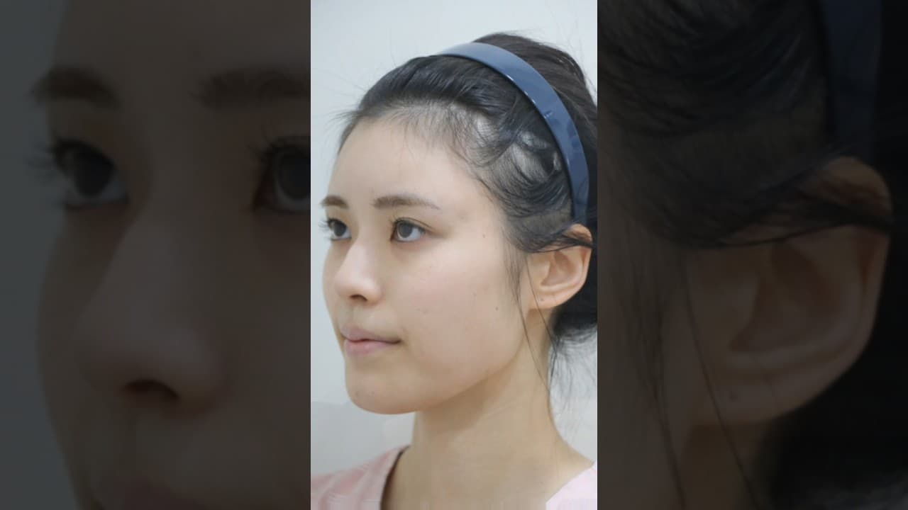 매부리코 낮은코가 고민이였어요