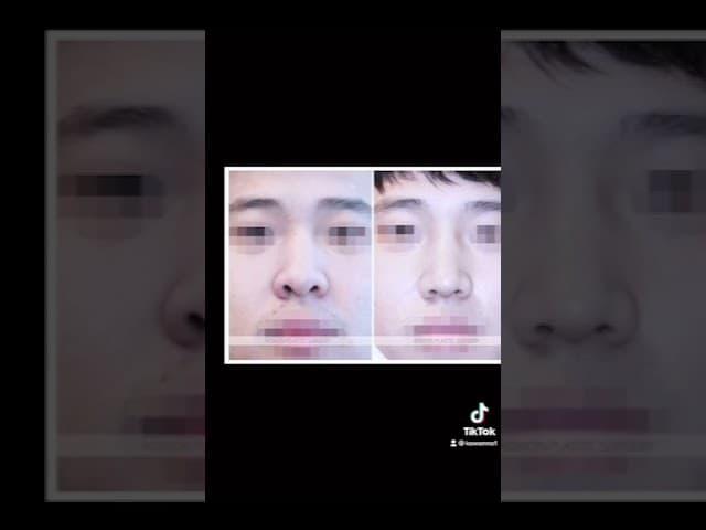 코원성형외과 코 성형 ★Before & After★_매부리코