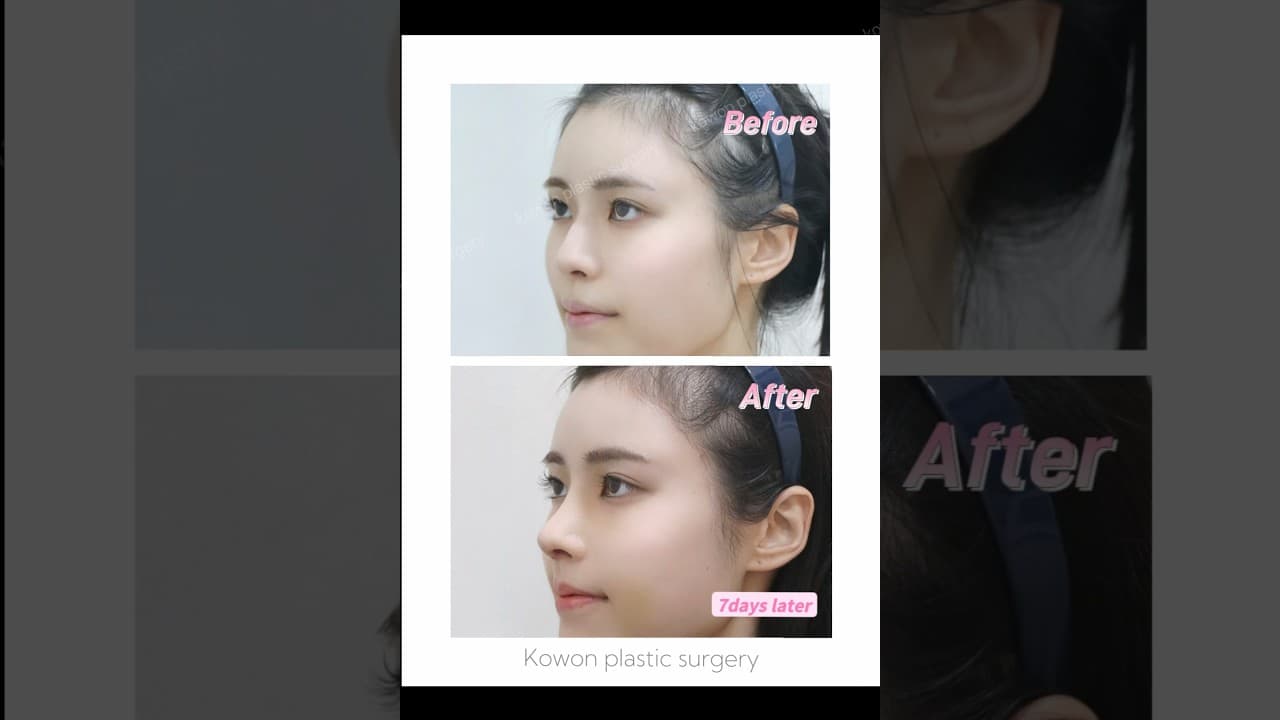 예쁘고 자연스럽게 코끝 개선 코원 코끝+매부리 교정 증례