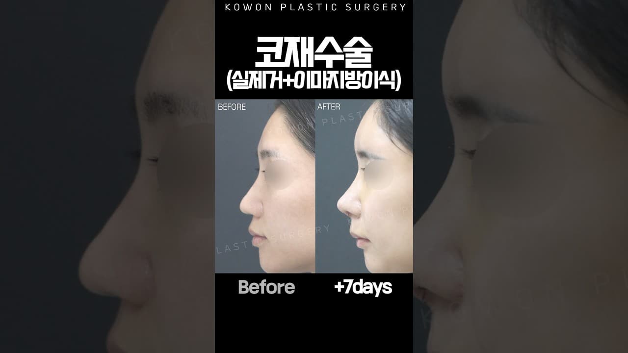 코수술했더니 남성적인 느낌… 재수술했더니?