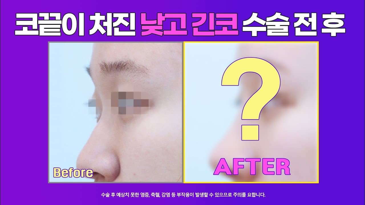 낮고긴코 수술전후 : 화살코, 처진코에서 코끝내림근제거를 해야하는 경우