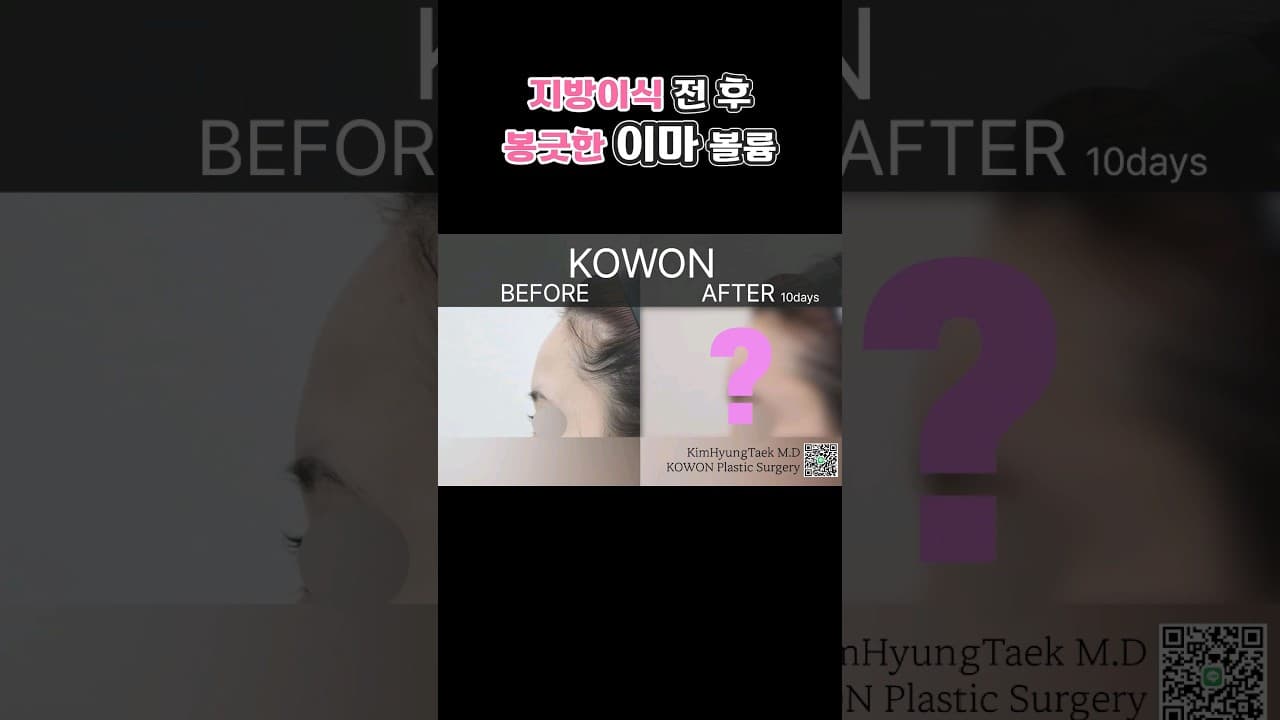 옆태 미인 되는 방법! 지방이식후 봉긋한 이마 볼륨 변화