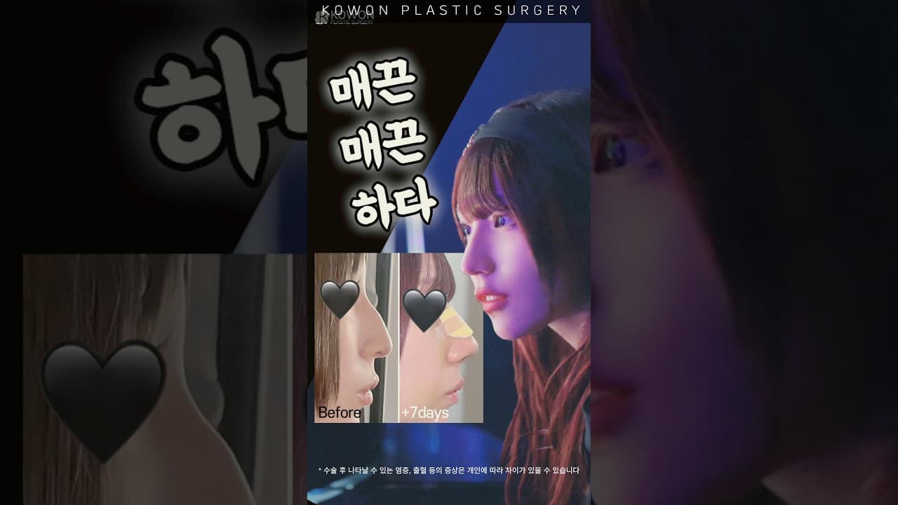 이건 매끈한 쪽 (매부리코 교정)
