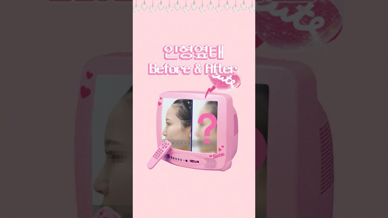 옆모습 인형같아졌나요? (코원성형외과 코교정 + 이마지방이식 + 비순각교정)