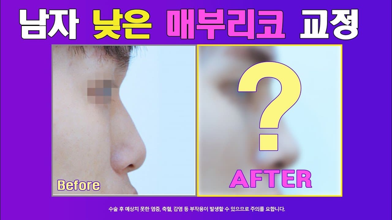 남자 낮은코 매부리코 남자다운 높은콧대로 교정