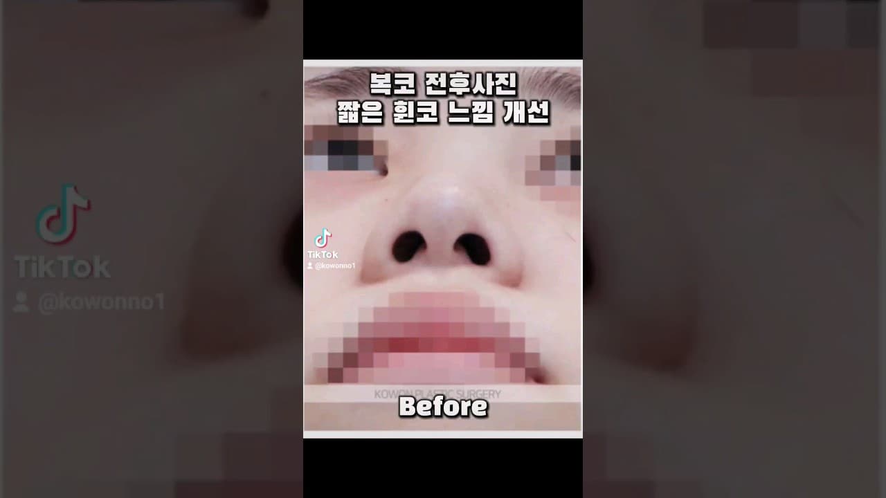 비중격연장 2주차 수술의 효과, 휜코 짧은코 개선 사례