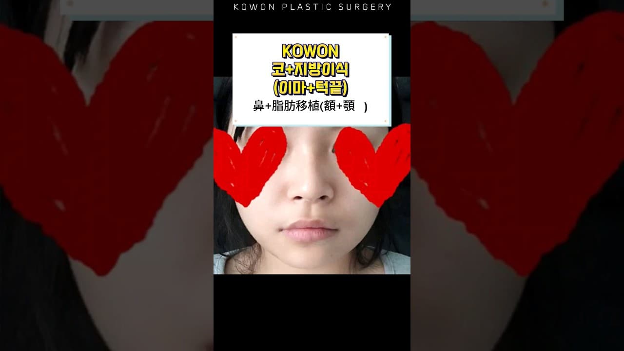 코+지방이식(이마+턱끝)했어요! #코원성형외과 #nosejobs