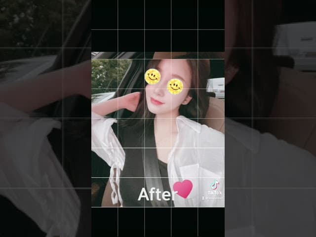 코원성형외과 코 성형 ★Before & After★