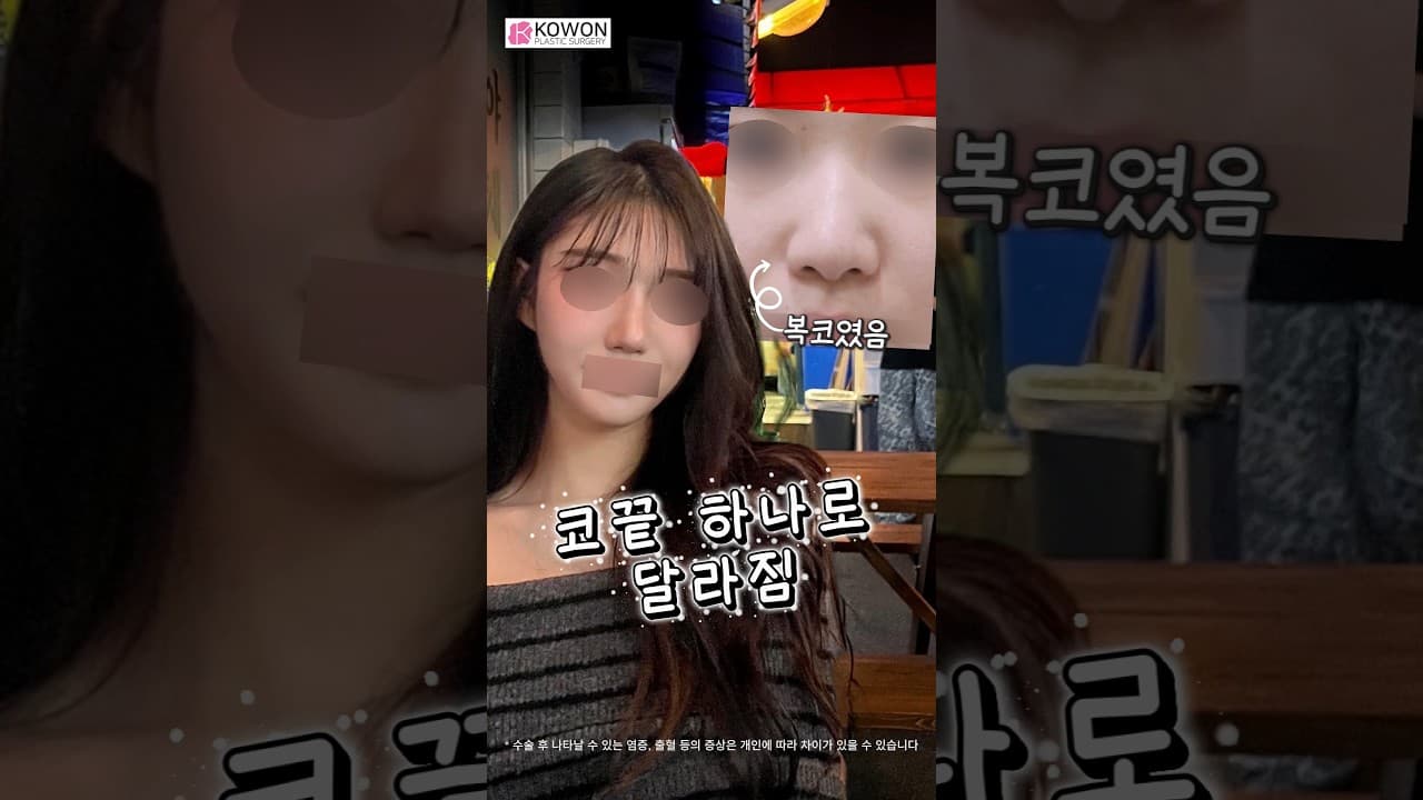 복코 성형 & 비중격만곡증 동시 교정! 기능과 미용을 한 번에 (기증늑+비중격만곡증+비염수술)