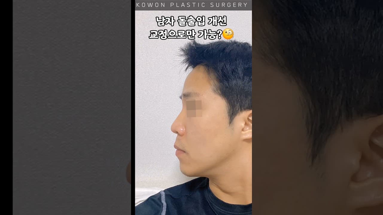 돌출입 고민개선 교정말고 다른 방법