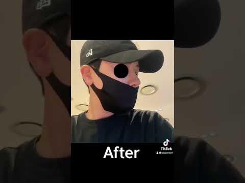 코원성형외과 코 성형 ★Before & After★