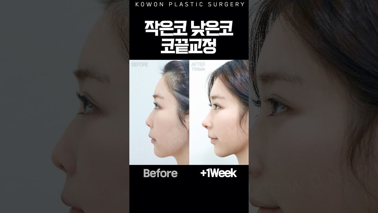 코끝 교정으로 인상이 이렇게 달라진다고?