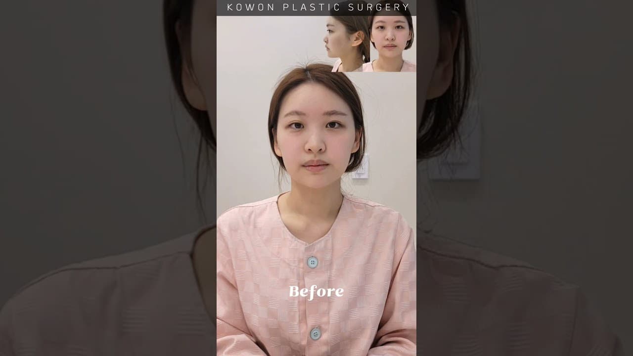 예쁜데 더 예뻐져버리기(코원 낮은코 교정 경과보기)