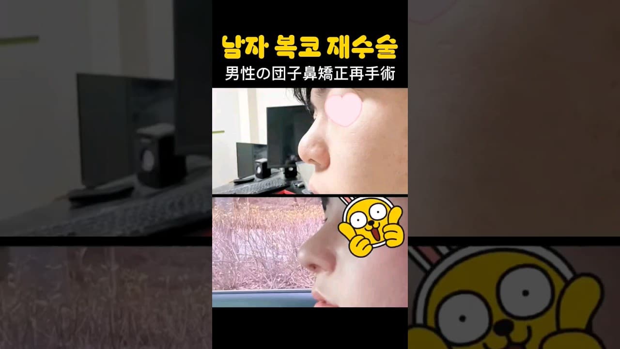 남자 복코 한달차 재수술 후기 | 여러 병원에서 복코개선 어려울거 같다했지만 재수술후 매우만족중입니다.