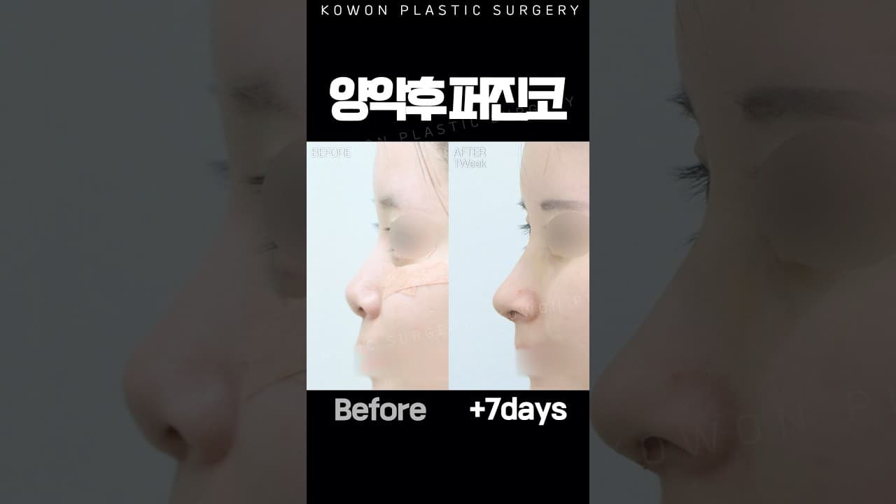 양악 후 코변형 퍼진 코 교정 사례 🌟