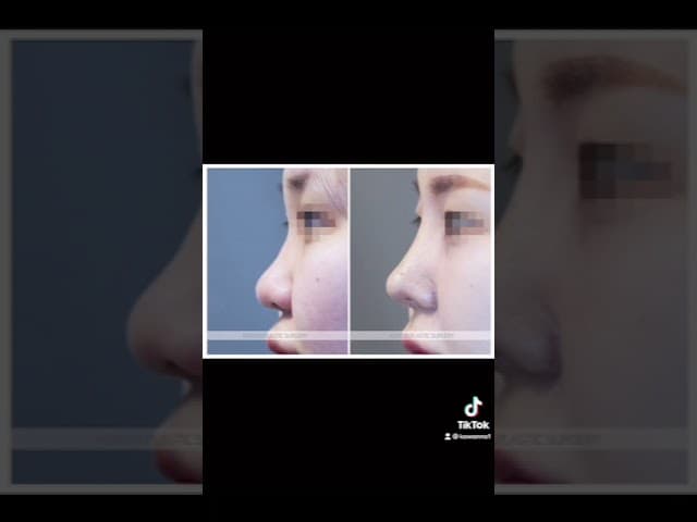 코원성형외과 코 성형 ★Before & After★_매부리코