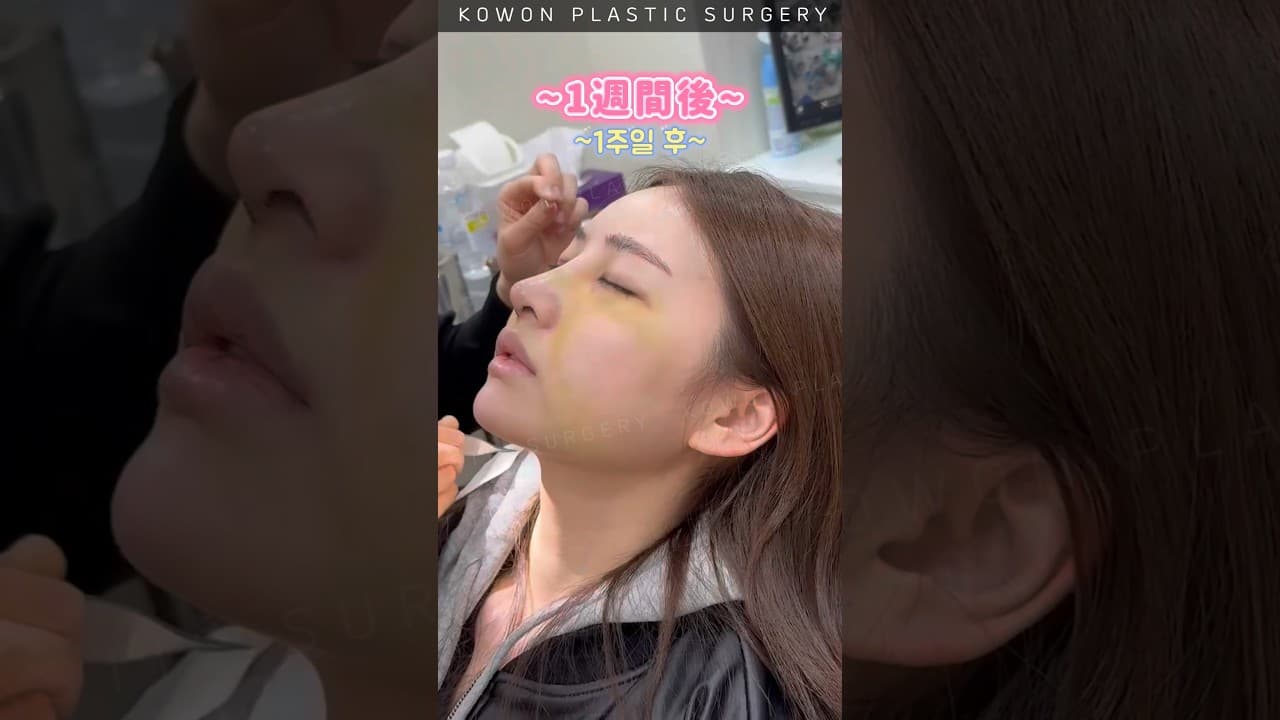 낮은코가 고민이라 여려병원을 알아보다 결국