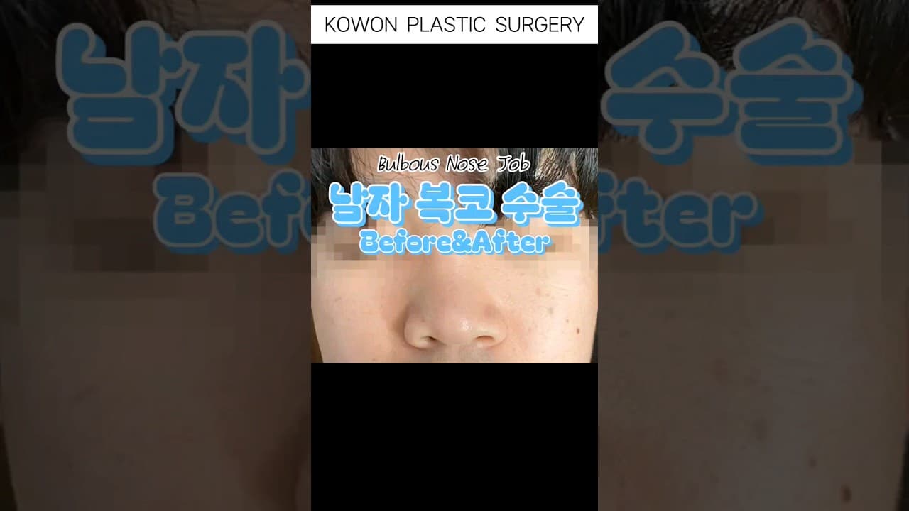 남자 복코 수술 후기